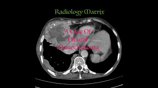 Pleural mesothelioma [upl. by Raseac]