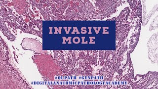 Invasive Hydatidiform Mole [upl. by Maxia362]