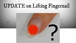 Tea Tree Oils Healing Powers On My LIFTED Fingernail  ONYCHOLYSIS  Does it Work  Watch Update [upl. by Plerre]