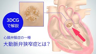 3DCGで解説！心臓弁膜症の一種「大動脈弁狭窄症」とは [upl. by Oigaib]