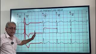 VENTRICULAR ECTOPICS  VENTRICULAR PREMATURE BEATS HOW TO DIAGNOSE ON ECG [upl. by Pentheam]