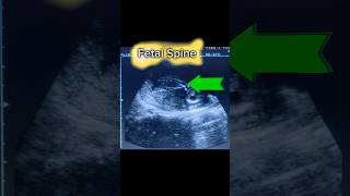 How to Obs Ultrasound Pregnancy Scan shorts [upl. by Assinna]