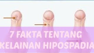 7 Fakta Kelainan HIPOSPADIA seperti Aprilia Manganang hipospadia aprilia [upl. by Llenad396]