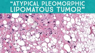 quotAtypical pleomorphic lipomatous tumorquot mimic of liposarcoma AIP France 2021  case 13 [upl. by Oiretule]