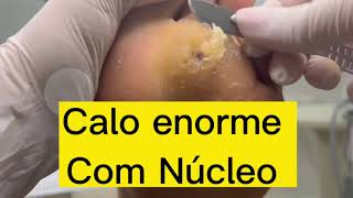 CALO COM NÚCLEO ENORME DESBASTE PLANTAR [upl. by Ahsenit]