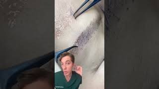 Eyebrow Hair Transplant How to Transform Your Brows [upl. by Marka149]