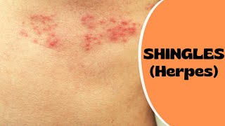 Shingles Symptoms amp Treatment  Eye Shingles  Post Herpetic Neuralgia  Shingles Vaccine [upl. by Anirahs]