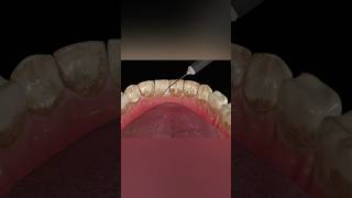 Dental Scaling Procedure medicalanimation health shorts [upl. by Dodge]