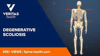 Degenerative Scoliosis [upl. by Montgomery]