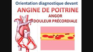 Syndrome coronarien aigu ANGINE DE POITRINE angor stable instable cours cardiologie conduite à tenir [upl. by Chew962]