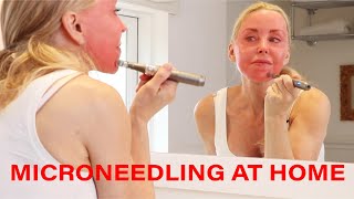 Microneedling DIY at Home  Tips Warnings and Demo  Over 50 [upl. by Dawaj]