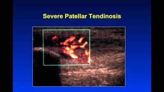 Introduction to Musculoskeletal Ultrasound [upl. by Nalla]