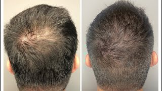 Minoxidil Conflugain Avis  Arnaque  Le Pire Minoxidil  Comment faire pousser sa barbe [upl. by Lehte352]