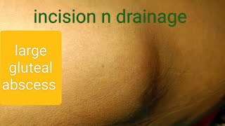 large gluteal abscess  incision n drainage dr youtube doctor [upl. by Aymik254]