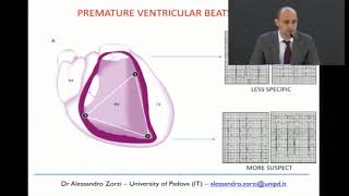 Arrhythmogenic right ventricular cardiomyopathy AZorzi [upl. by Nerhtak]