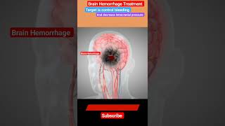 Brain Hemorrhage Treatment l Mannitol l Craniotomy stroke shorts [upl. by Nayk]