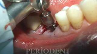 Molar Extraction and Immediate Implant Placement [upl. by Odell]