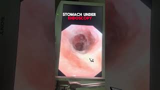 Understanding Stomach Ulcers An InDepth Look Under Endoscopy [upl. by Tyler]