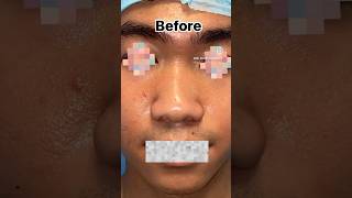 Asian Rhinoplasty by Dr Anil Kumar Kaler Nose job delhi nosejobs asian Contact8448150908 [upl. by Lamberto820]