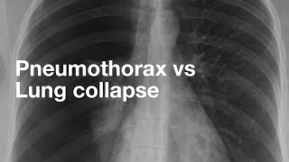 Pneumothorax vs Lung Collapse [upl. by Sherm]