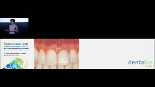 Peri Implant Mucositis Peri Implantitis Where Are We At [upl. by Duval]