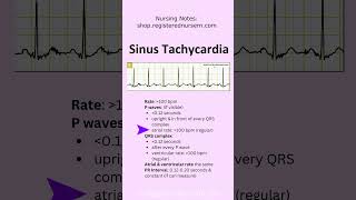 Sinus Tachycardia EKG ECG Rhythm Nursing Review in 60 Seconds shorts ecg nursing [upl. by Gokey431]