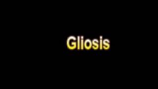 What Is The Definition Of Gliosis  Medical Dictionary Free Online Terms [upl. by Serolod]