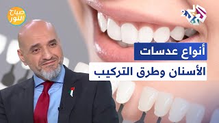 صباح النور l عدسات الأسنان أو الفينير الأنواع وطرق التركيب [upl. by Elleiad]