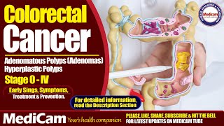 Colorectal Cancer Sings Symptoms And Treatment [upl. by Cobbie911]