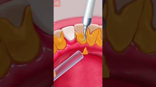 The surprising truth about ASMR teeth cleaning [upl. by Meeki]