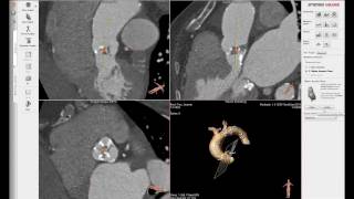 Presentation of 3mensio Valves at EuroPCR by Lutz Buellesfeld [upl. by Gleason]