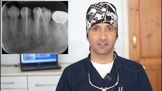 Root Canal Treatment of the Mandibular Second Premolar and First Molar Tooth In a Single Sitting [upl. by Dowling]