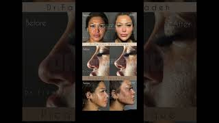 DrFarzan Malekzadeh  Picasso Technique no Surgery beauty picassotechnique drfarzanmalekzsdeh [upl. by Ellehsat]