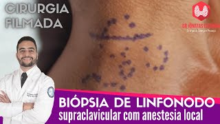 Biopsia de linfonodo supraclavicular com anestesia local  Cirurgia completa [upl. by Weyermann638]