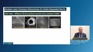 Role of laser atherectomy in coronary in stent re stenosis ISR [upl. by Hgieliak]