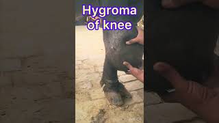 Hygroma of knee l Dr Umar Khan [upl. by Laoj394]