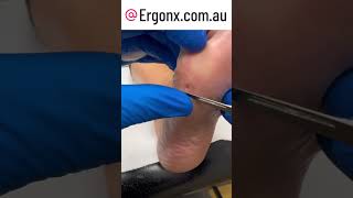 Large corn removal from foot by podiatrist in australia very satisfying tonwatch and for the pati [upl. by Milissent]