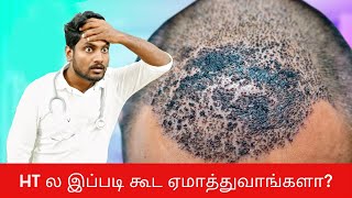 Is Hair Transplant results permanent   Shocking truth revealed [upl. by Berg]