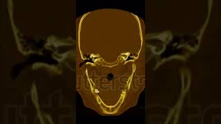 Para nasal sinus ka CT scan medicalanimation medicalimaging medicaltest ctscan hospital [upl. by Joub40]