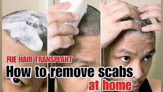 How to remove scabs after hair transplant  cleaning your scalp at home  FUE IN THE PHILIPPINES [upl. by Wun]