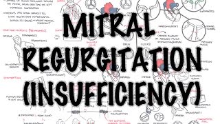 Mitral Reguritation insufficiency  Overview signs and symptoms pathophysiology treatment [upl. by Ellehcir958]