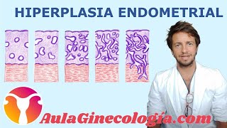 HIPERPLASIA ENDOMETRIAL Qué es tratamiento riesgo de cáncer  Ginecología y Obstetricia [upl. by Stanly]