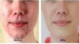 Ek Din Mein kaise acne pimple aur uske Daag dhabbo ko hataye 100 natural tarike se [upl. by Suinotna]