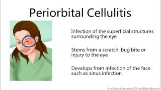 Periorbital cellulitis [upl. by Conlon]