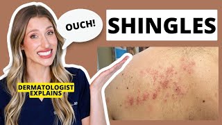 Dermatologist Explains Shingles Is it Contagious Shingles Treatments amp Prevention  Dr Sam Ellis [upl. by Egap]