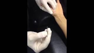 Abductor Pollicis Brevis Dry Needling [upl. by Daffi423]