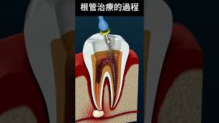 根管治療的過程 dentist 牙齒 [upl. by Airetnohs]