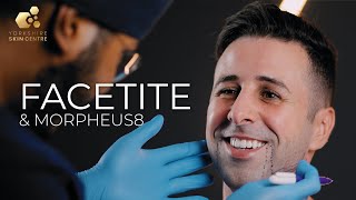 Facetite amp Morpheus8  Yorkshire Skin Centre  Dr Raj Thethi [upl. by Tallou]