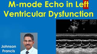 M mode Echocardiogram in Left Ventricular Dysfunction [upl. by Madelyn383]