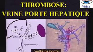 Thrombose de la veine porte hepatique diagnostic imagerie [upl. by Camel]